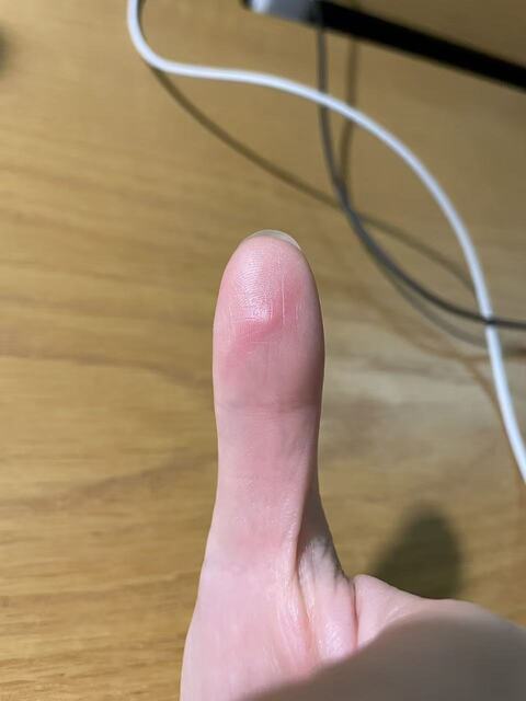 现在知道严刑拷问时被烧红的烙铁烫到是多么痛苦了